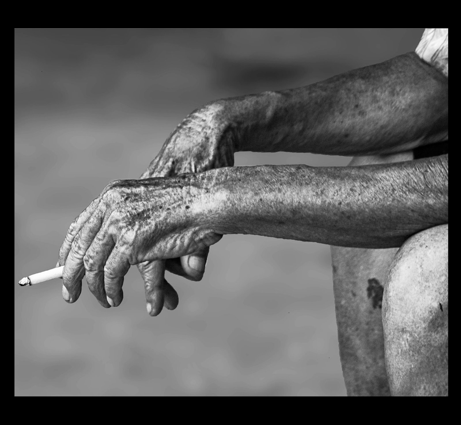 La cigarette et les problèmes de peau : arrêter de fumer par hypnose avant d'avoir des soucis de santé